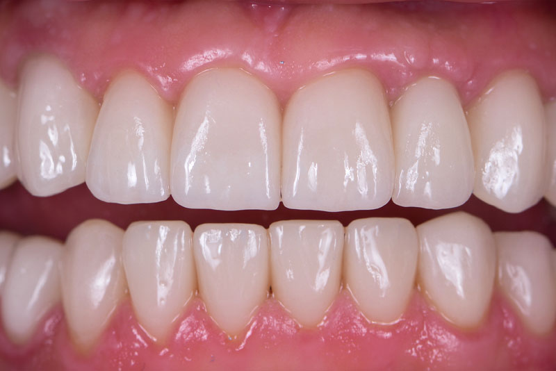 after dental procedure