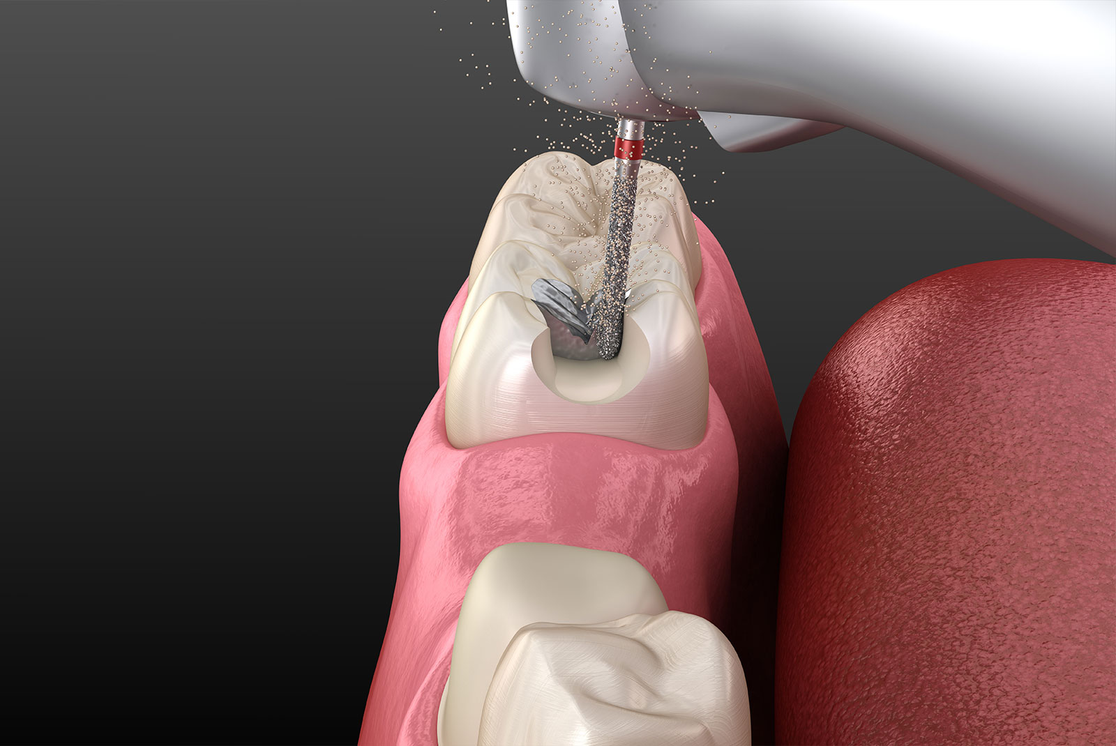 Amalgam removing and preparation for ceramic crown placement. 3D illustration