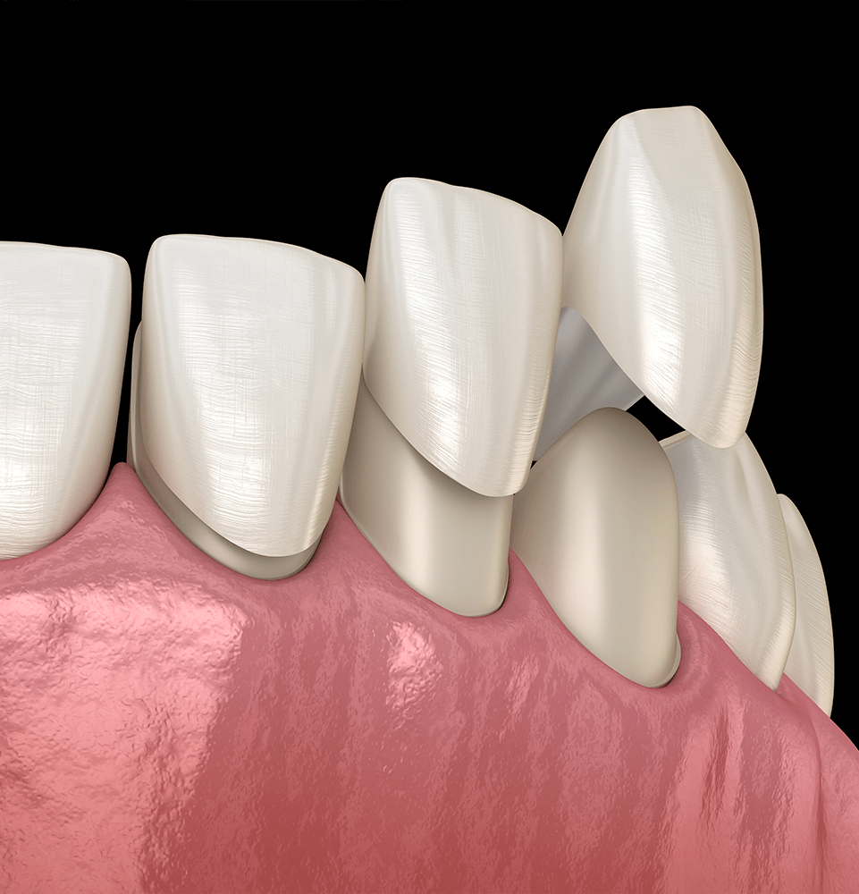 illustration of dental veneer