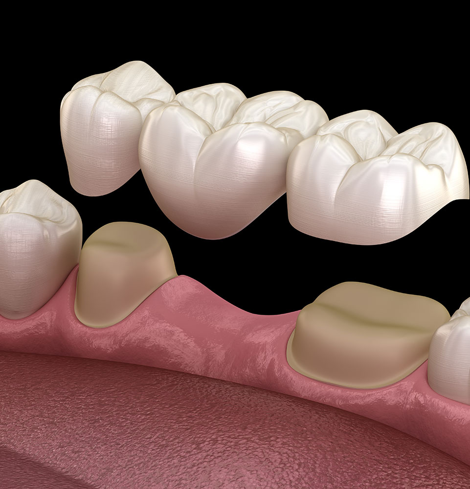 dental bridge illustration