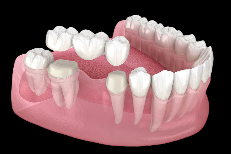 illustration of dental bridge
