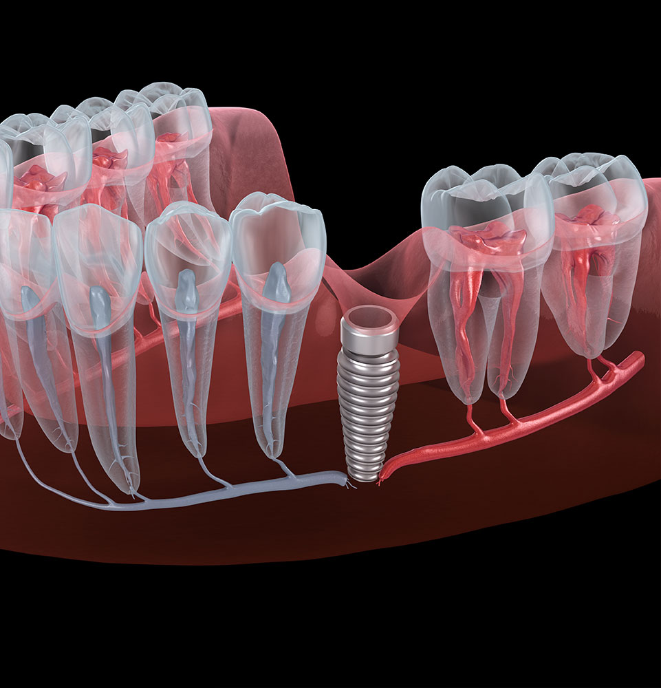 Result of unsuccessful dental implantation - nerve break. Medically accurate dental 3D illustration