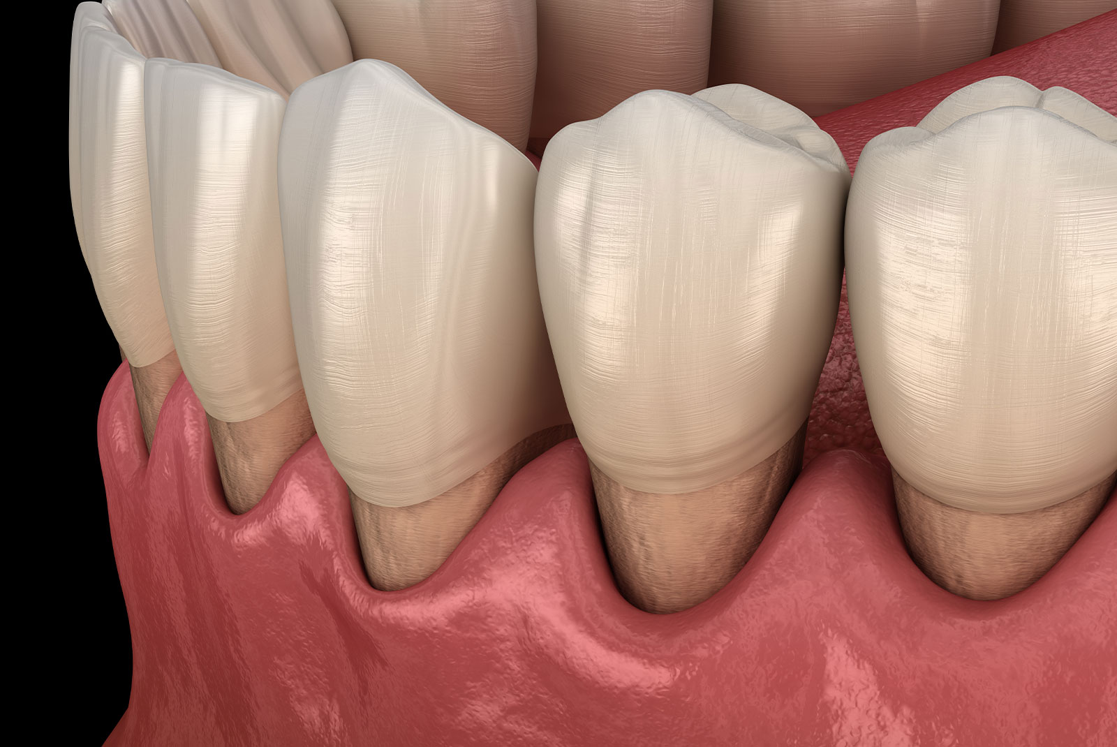 Gum recession process