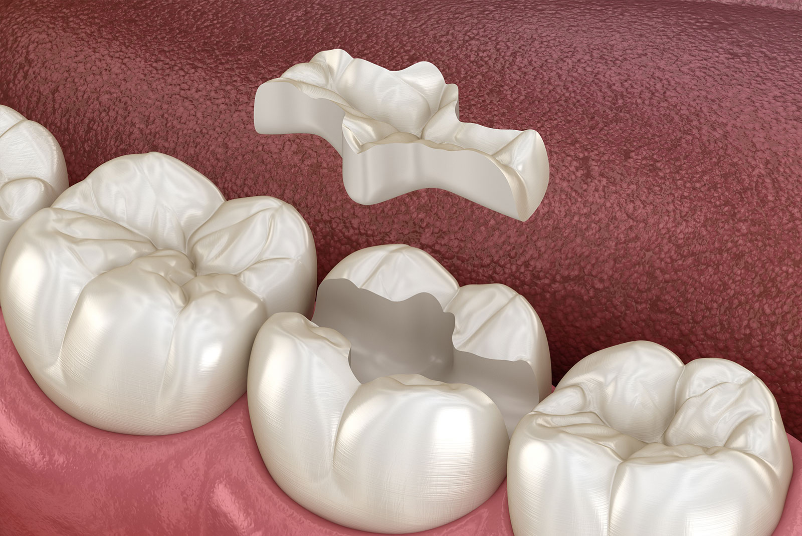 Inlay ceramic crown fixation over tooth. Medically accurate 3D illustration of human teeth treatment
