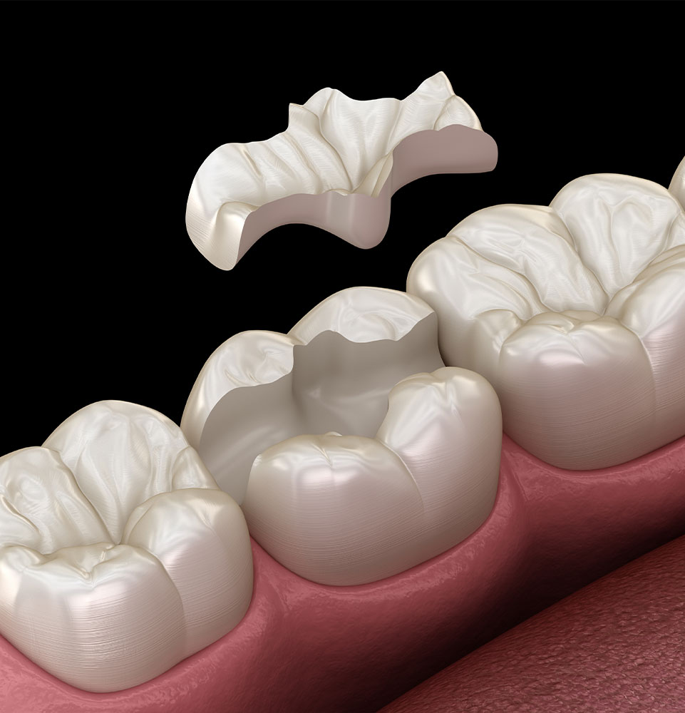 Inlay ceramic crown fixation over tooth. Medically accurate 3D illustration of human teeth treatment