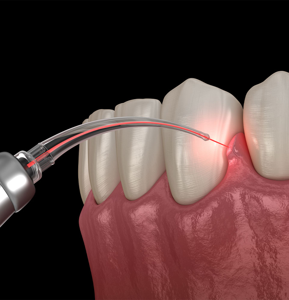 illustration of laser dentistry