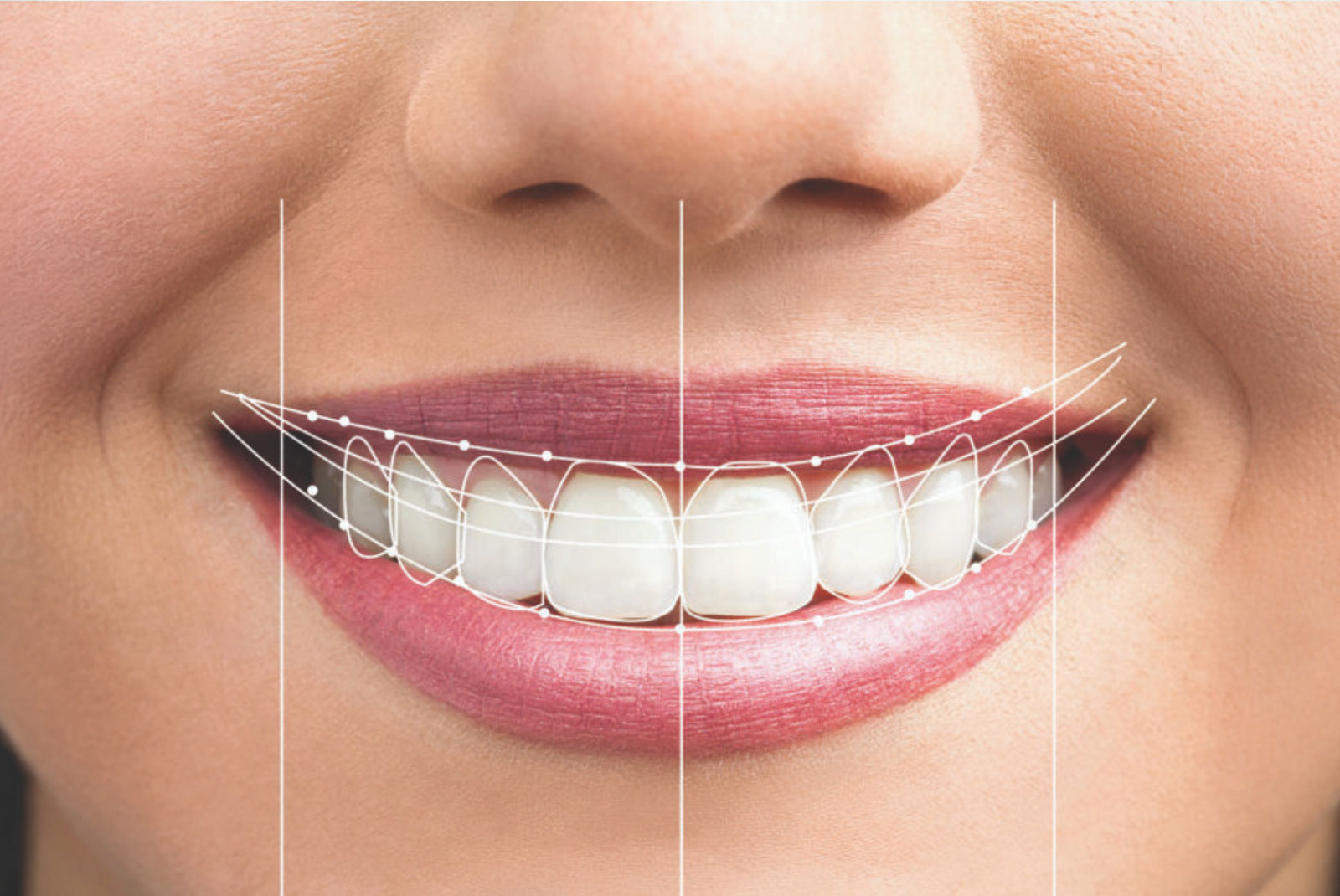 smile design preview