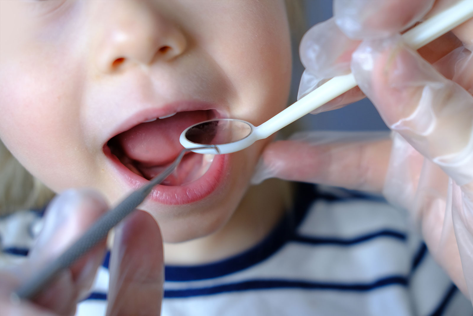 close up pf dental patient being examined for tongue tie treatment