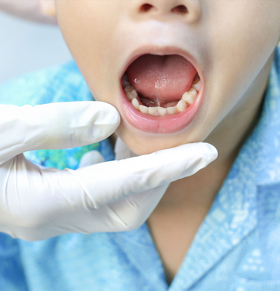 close up pf dental patient being examined for tongue tie treatment