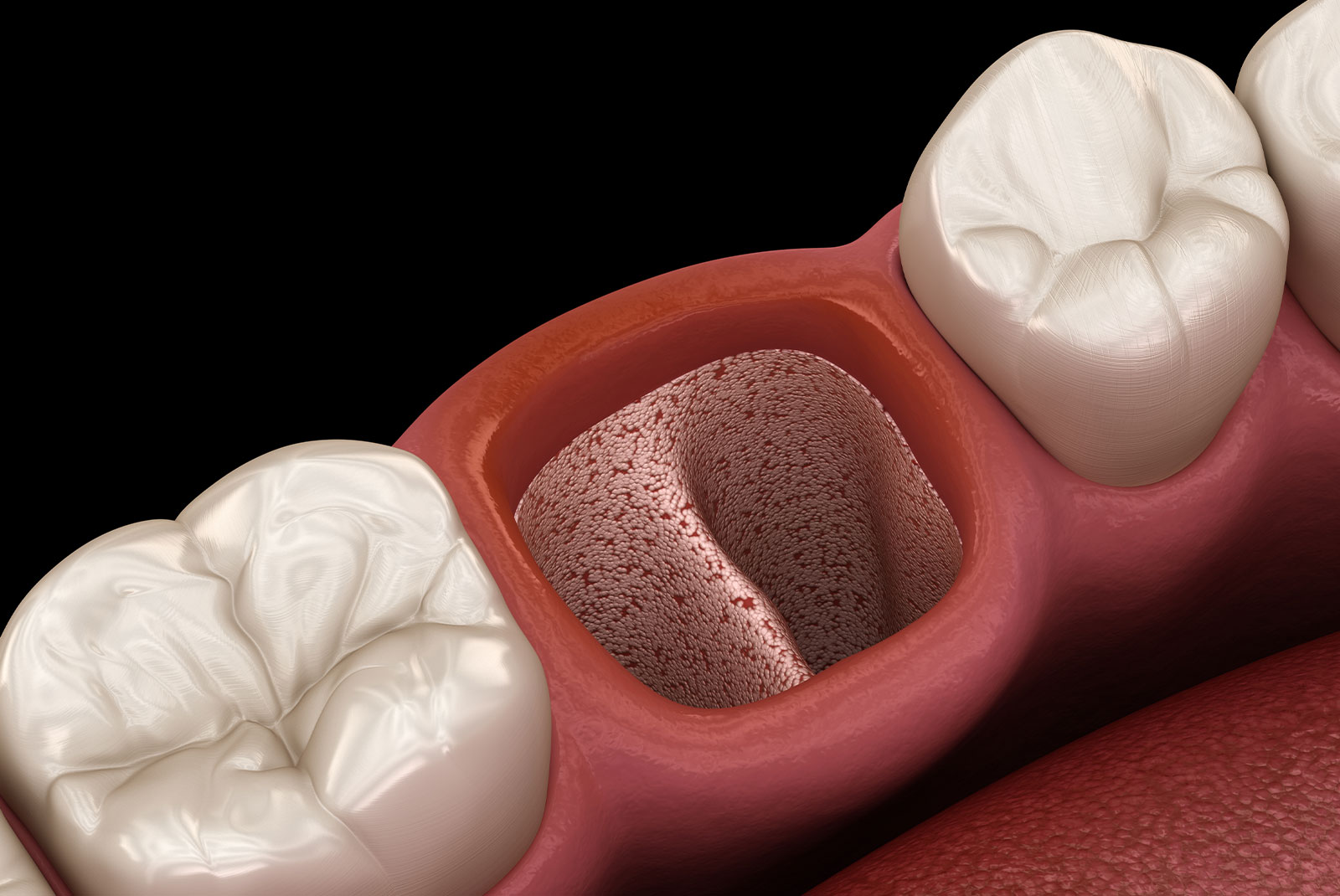 opened dry soket after tooth extraction. Medically accurate 3D illustration