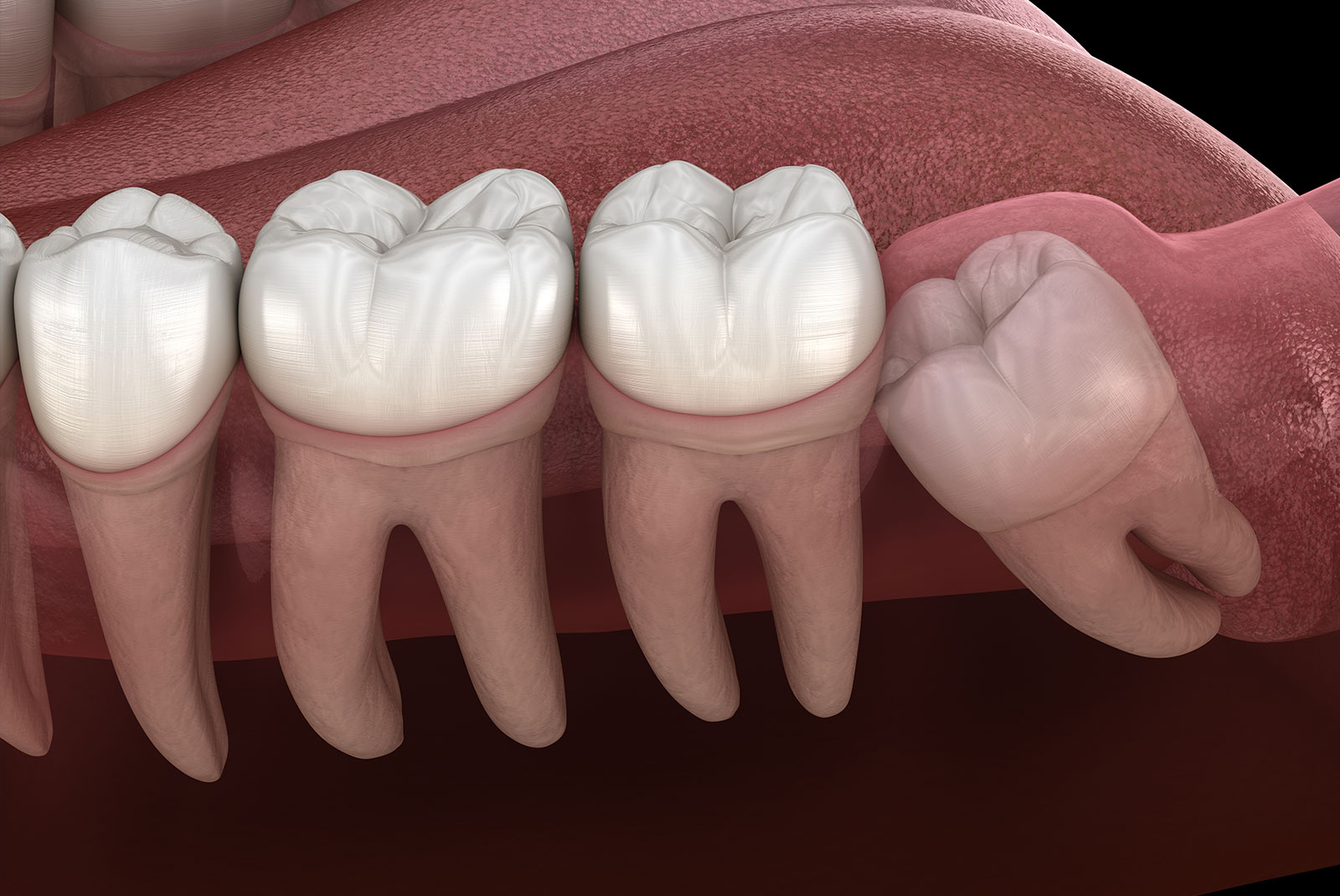 Wisdom tooth with impaction at molar tooth. Medically accurate tooth 3D illustration
