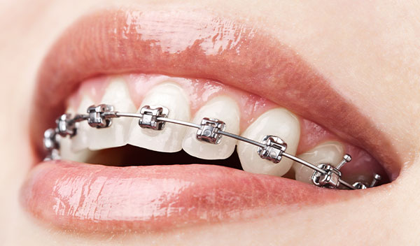 close up of mouth with metal braces