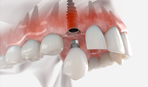 illustration of zirconia dental implant