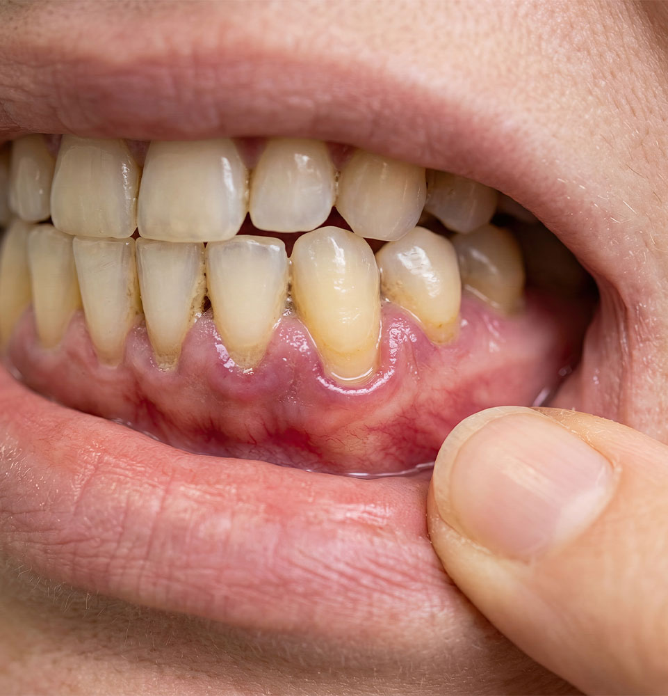 close up of person experiencing gum recession