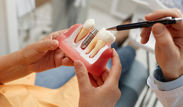traditional dental implant model